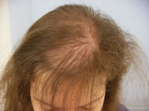 Penumbuh Rambut Kepala - Telogen effluvium Penumbuh Rambut, Penumbuh Rambut Dikepala, Obat Penumbuh Rambut