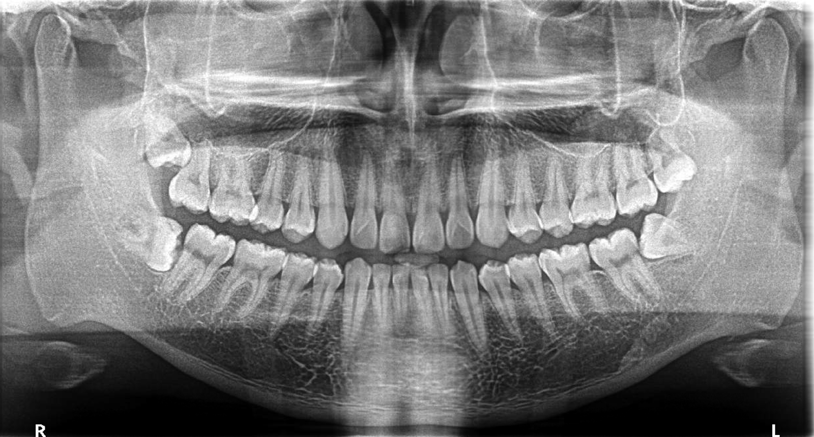 Wisdom Teeth are seen growing sideways. 