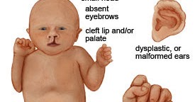 What Is Trisomy 13 Syndrome