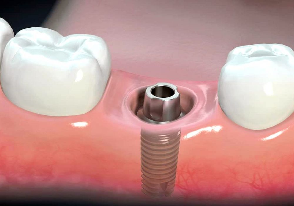 DENTAL IMPLANTS Surgical aftercare and complications