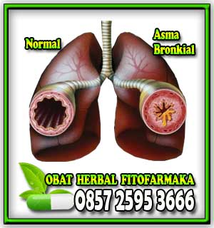 Sakit Asma asma, penyakit asma, obat asma, penyebab asma, paru-paru asma