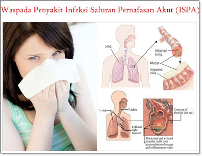 Penyakit ISPA (Infeksi saluran pernapasan akut) - Guntur Sapta Blog