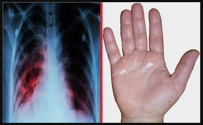 Kamu Harus Ngerti !! Ciriciri Gejala Paruparu Basah Yang