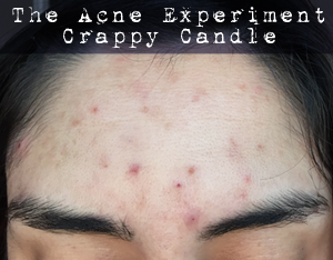 Rosehip Seed Oil Review - The Acne Experiment | Crappy Candle rosehip oil breakout