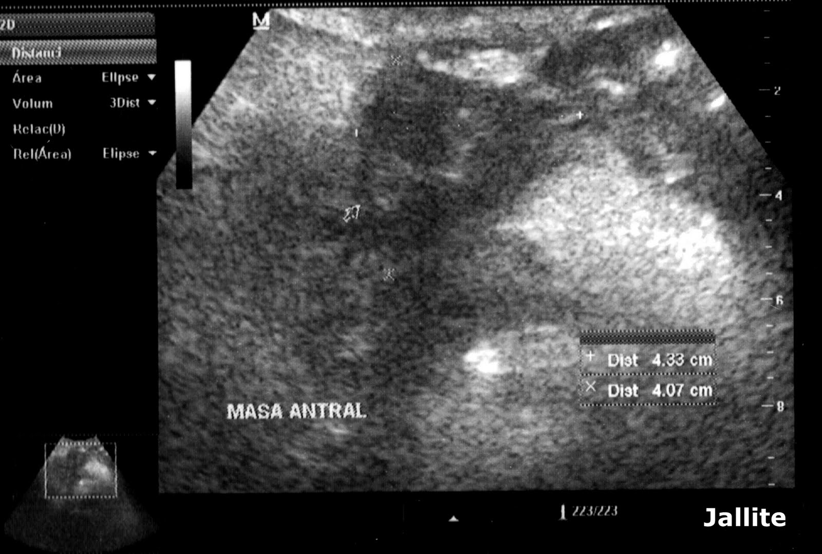 Cancer de Estomago y....