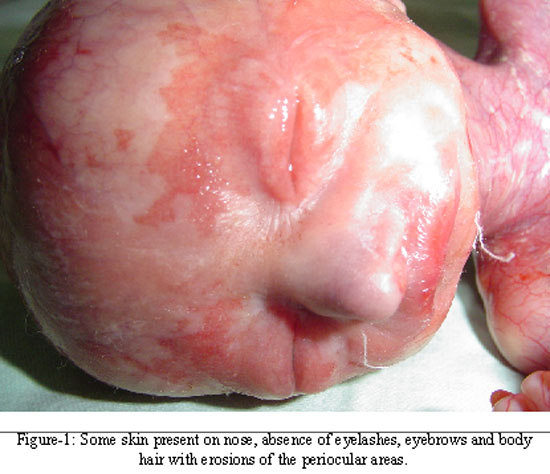 Aplasia cutis congenita | Genetic and Rare Diseases ...