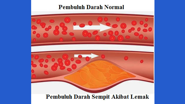 Inilah Tanda-Tanda Pembuluh Darah Tersumbat Inilah Tanda-Tanda Pembuluh Darah Tersumbat