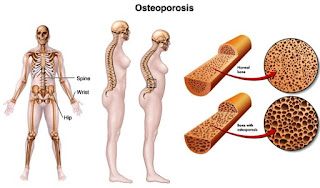 Postural Changes Due to Osteoporosis