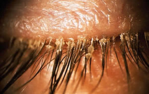demodex en el cabello
