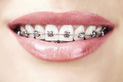 Niềng răng thẩm mỹ điều trị khớp cắn ngược là gì?