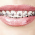Niềng răng thẩm mỹ điều trị khớp cắn ngược là gì?