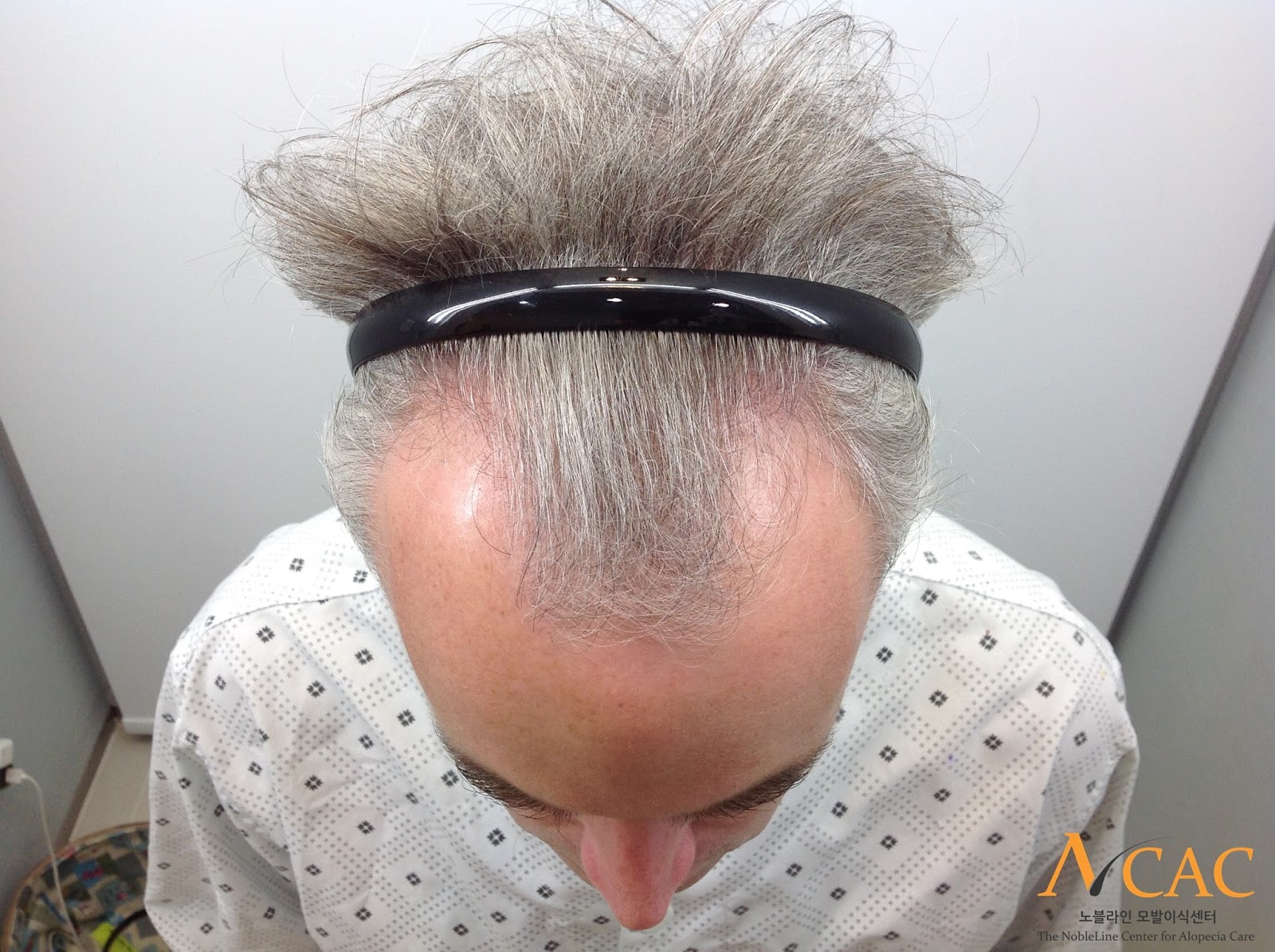 2500 Grafts Result Fue Hair Transplant After 1 Year