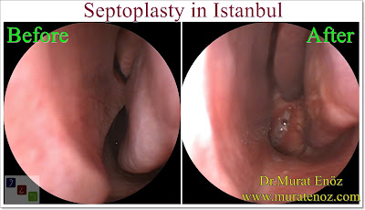How Much Does a Septoplasty Surgery Cost? - How Much Does a Septoplasty Surgery Cost in Turkey? - Septoplasty Cost in istanbul - Septoplasty Surgery in İstanbul - What Is The Cost Of Septoplasty in Istanbul, Turkey - Septoplasty İstanbul - Deviated Septum Before and After Septoplasty in İstanbul How Much Does a Septoplasty Surgery Cost? - How Much Does a Septoplasty Surgery Cost in Turkey? - Septoplasty Cost in istanbul - Septoplasty Surgery in İstanbul - What Is The Cost Of Septoplasty in Istanbul, Turkey - Septoplasty İstanbul - Deviated Septum Before and After Septoplasty in İstanbul