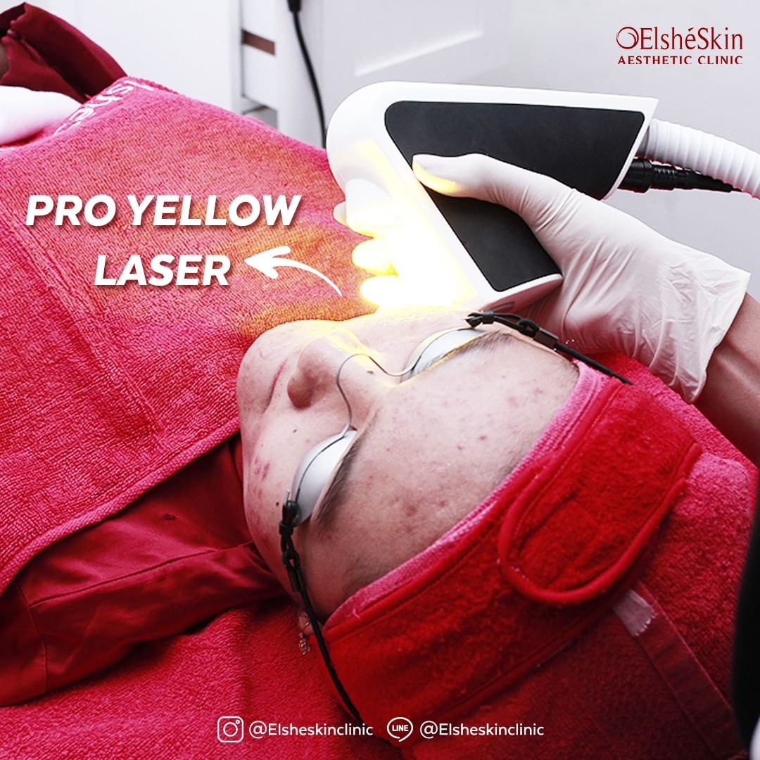 Pro Yellow Laser Elsheskin Clinic