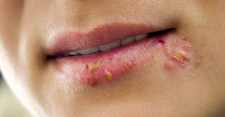 Tratamiento Para Herpes Tratamiento Para Herpes