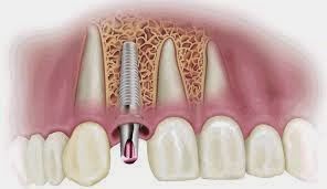 http://www.dentistinchennai.com/implant-procedures.php