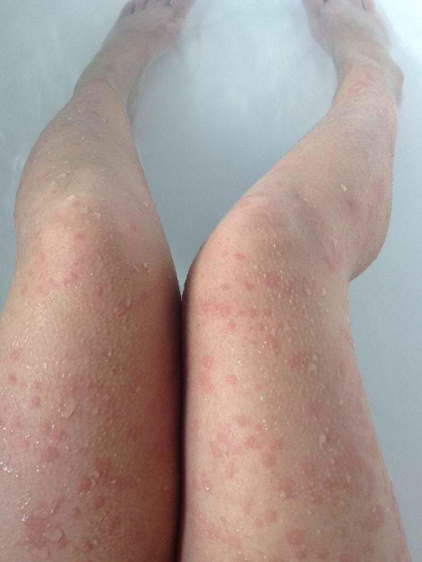 Netizen warns of the dangers from cold urticaria