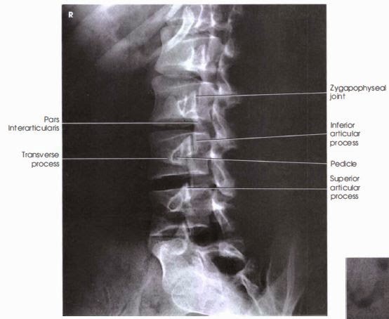 AP Oblique Lumbar spine radiograph