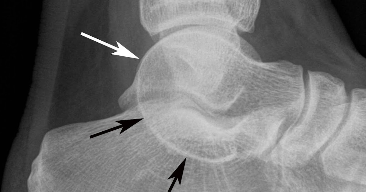 Tarsal Coalition Awareness: What is a Tarsal Coalition?