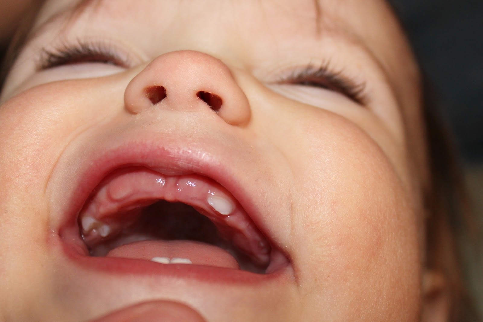Лезут зубы у ребенка постоянно. Прорезывается Нижний боковой резец. Десна при прорезывании зубов. Десна при прорезывании первых зубов.