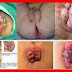Obat Oles Untuk Benjolan Wasir Internal Yang Prolaps thumbnail