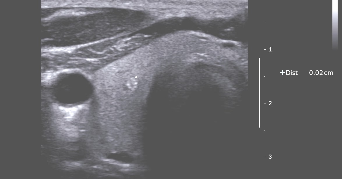 Vietnamese Medic Ultrasound Case Thyroid Cancer Dr Phan Thanh