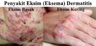 Bagaimana Mengobati Gatal Eksim?, Mengobati Gatal Karena Eksim Dengan Herbal Ampuh, obat gatal eksim