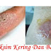Obat Eksim Tradisional