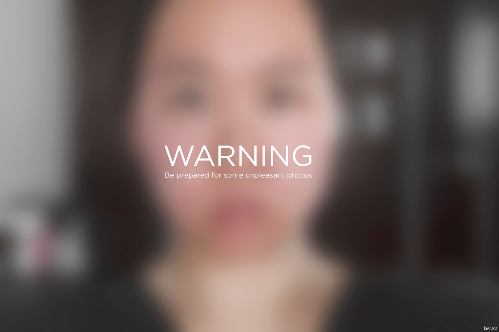 lavlilacs skin allergy - warning