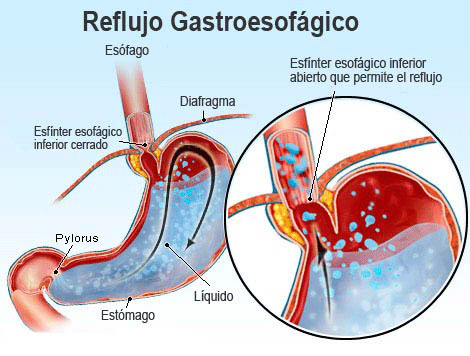 Como quitar el reflujo biliar