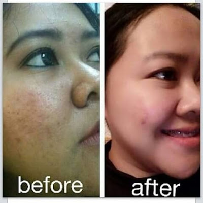 Rekomendasi Cream Penghilang Jerawat Pada Wajah Rekomendasi Cream Penghilang Jerawat Pada Wajah