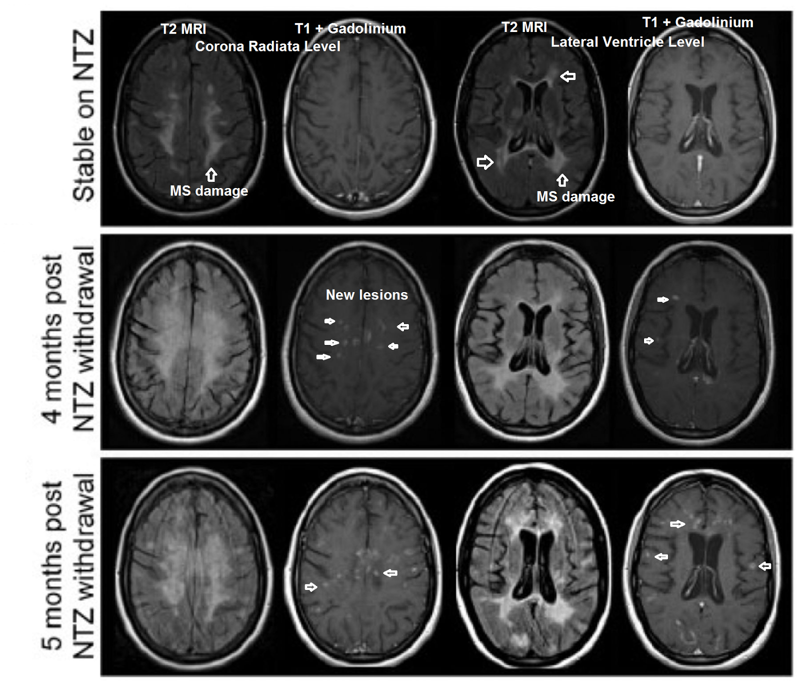 Will The Real Ms Stand Up Rebound Death Indicates Peripheral Immunity