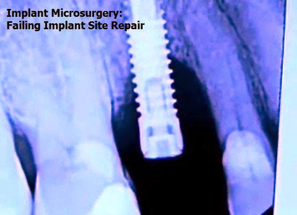 IMPLANT MICROSURGERY: Failing Implant Site Repair