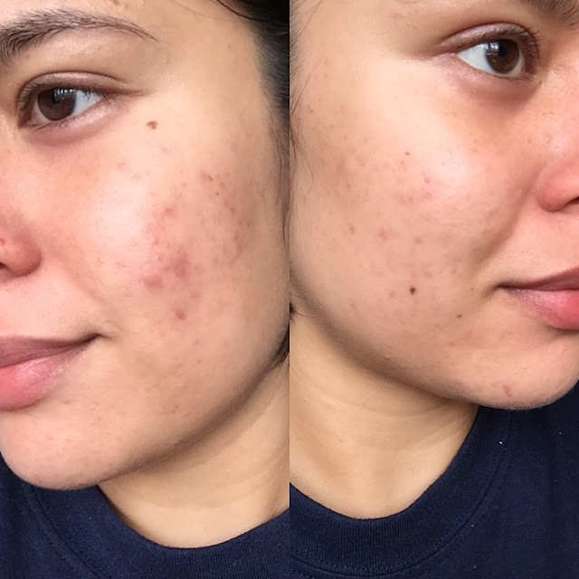 Retin A Before and After Photo - During Tretinoin Purge