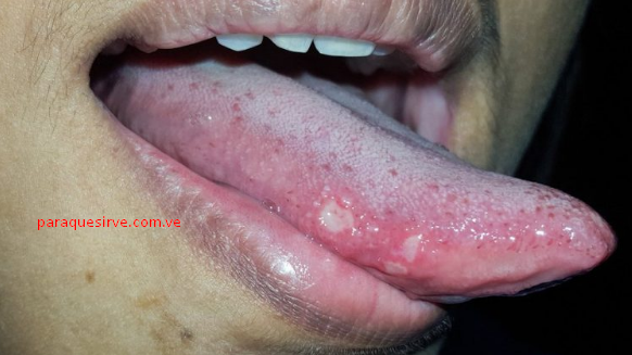 Como curar llagas en la lengua.