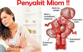 Pengobatan Tradisional Penyakit Mioma Uteri