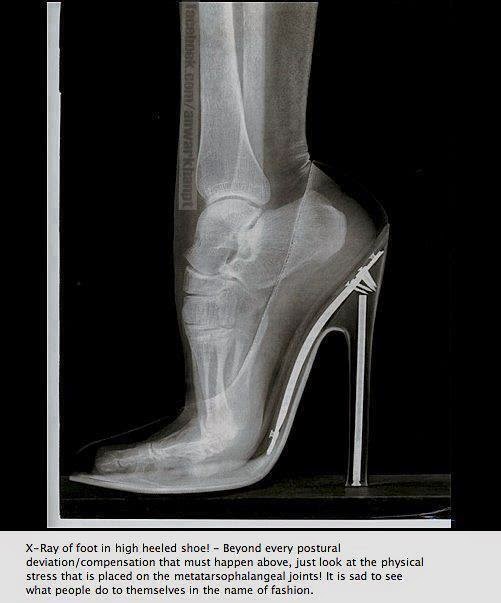 High Heel X Ray Of Foot In High Heel Shoe