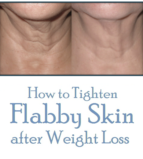 How to Tighten Flabby Skin after Weight Loss