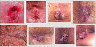 Obat Wasir Obat Wasir