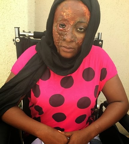 ini edo acid attack victim ini edo acid attack victim
