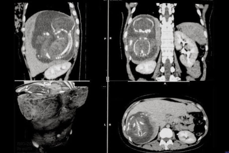 Imaging Anatomy SMS Miracle baby 'grew in liver'