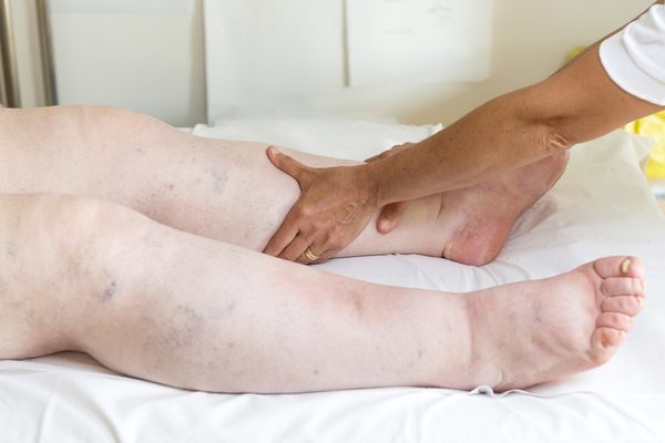القدمان المتورمتان ، على سبيل المثال ، ليستا بالضرورة من أعراض السرطان