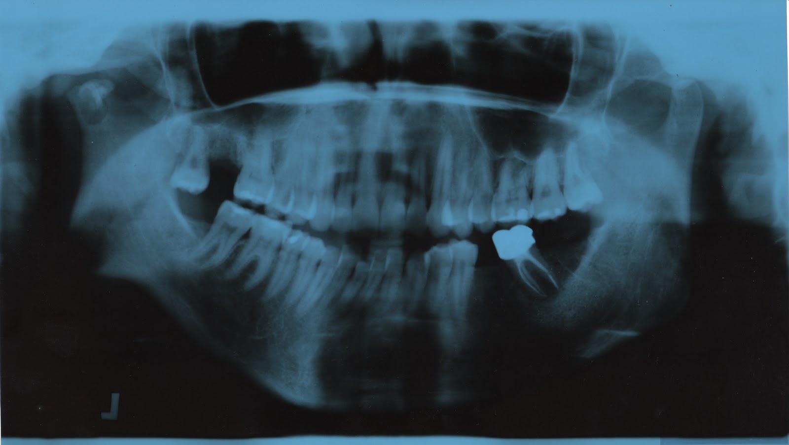 Getting everything straight. My double jaw surgery Xrays