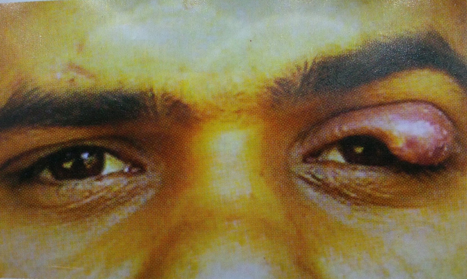 Brief Description, Types, Sign and Symptoms, Causes And Treatment Of