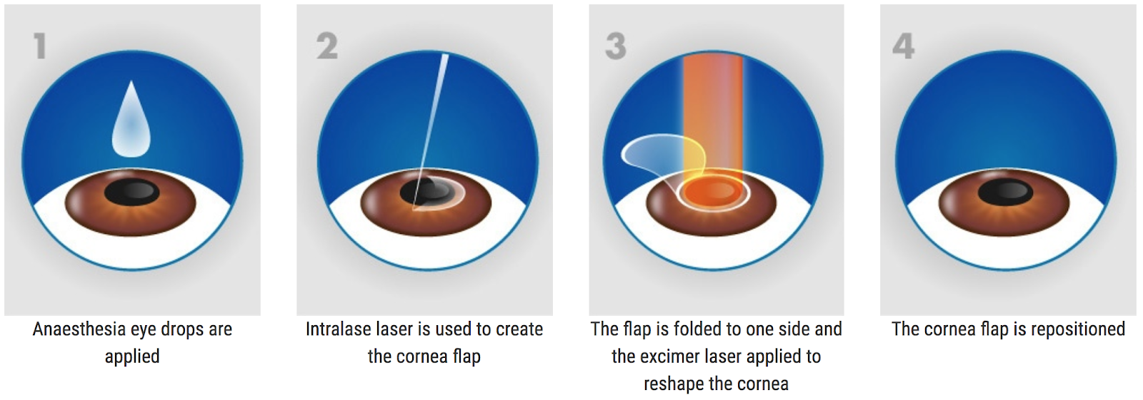 Коррекция зрения сравнение. Операция на глаза методом ласик. Метод ласик лазерная коррекция. Лазерная коррекция зрения ласик. Лазерная коррекция методом Фемто ласик.