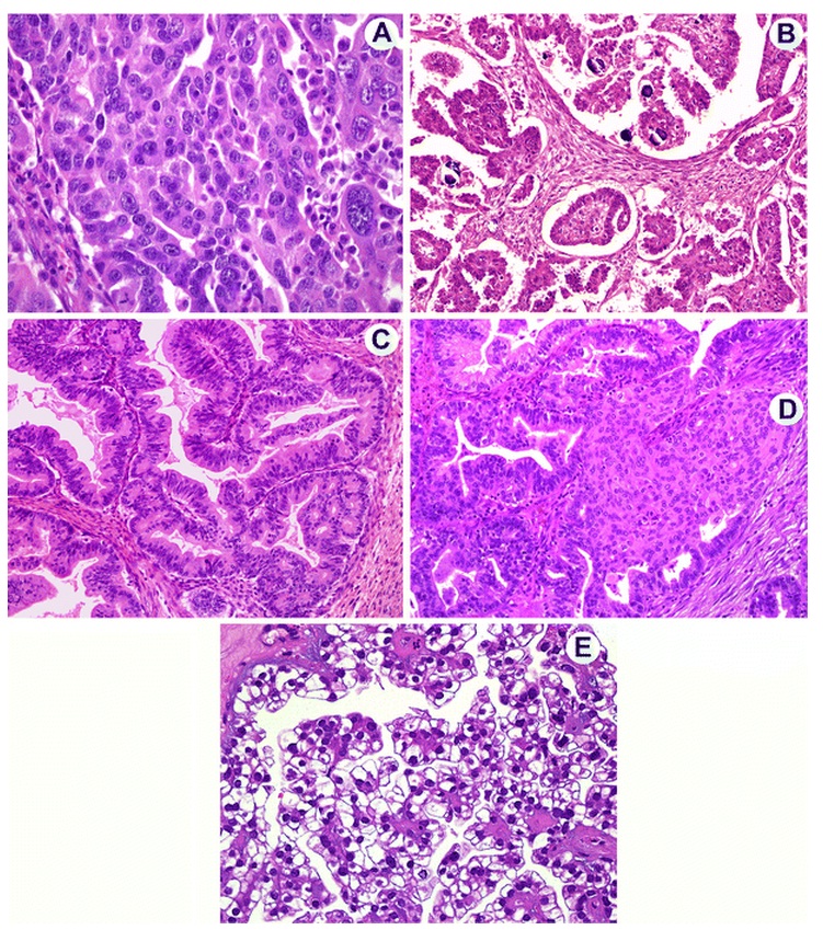 PATHfinder: Ovarian carcinomas as five distinct diseases.