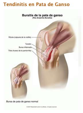 tendinitis aductores tiempo recuperacion