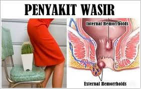 Obat wasir Herbal Terbukti paling Ampuh