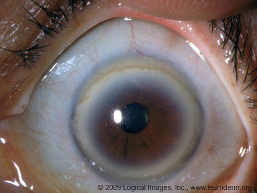 alis volat propriis: Corneal arcus