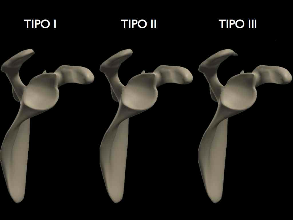 Medicina Deportiva Síndrome de Impingement o Pinzamiento Subacromial de Hombro. Medicina Deportiva Síndrome de Impingement o Pinzamiento Subacromial de Hombro.